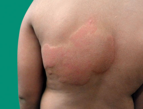 انواع روش های درمان کهیر در خانه و طب سنتی و گیاهان دارویی