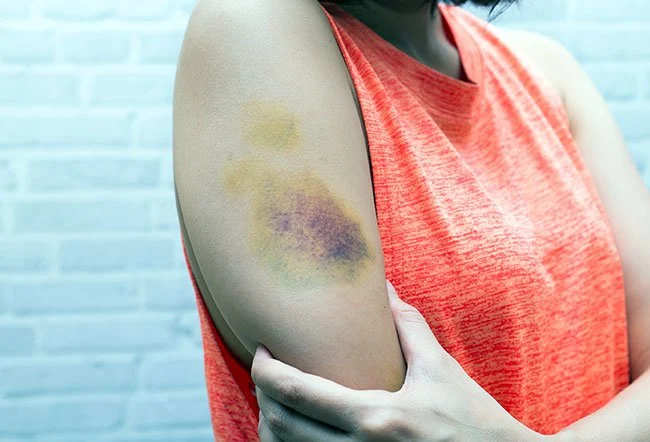 درمان خانگی کبودی با ۷ روش واقعی و موثر